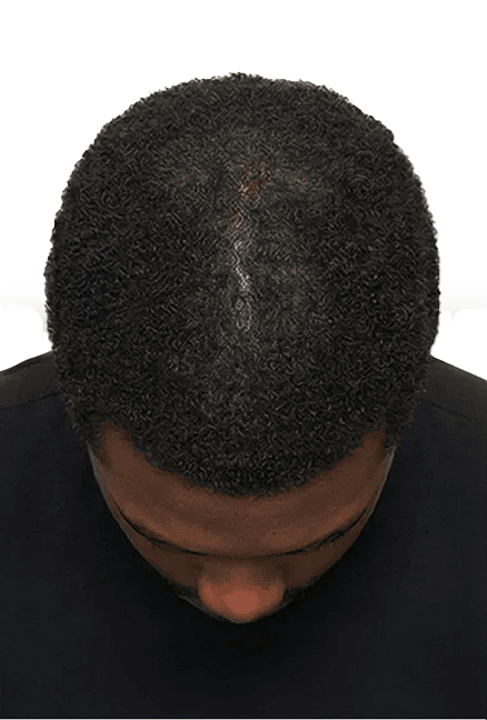 Month 0