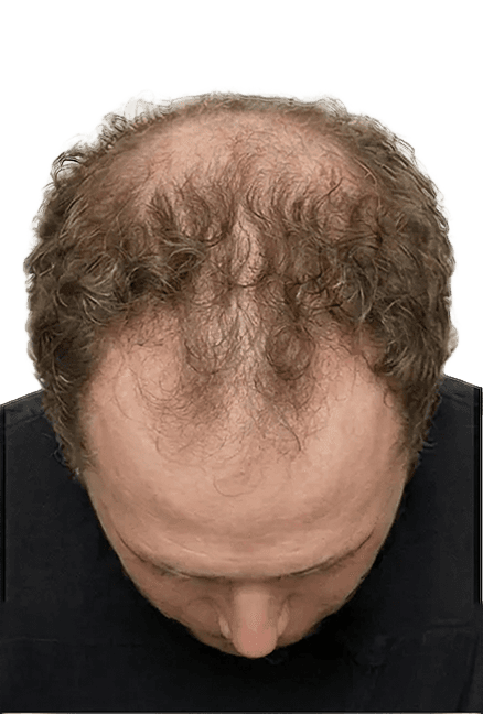 Month 0