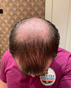Month 0
