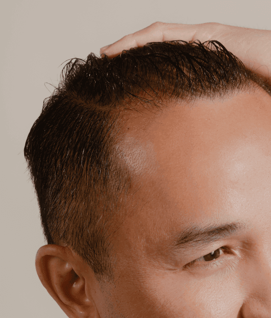 Topical Finasteride and Minoxidil Product
