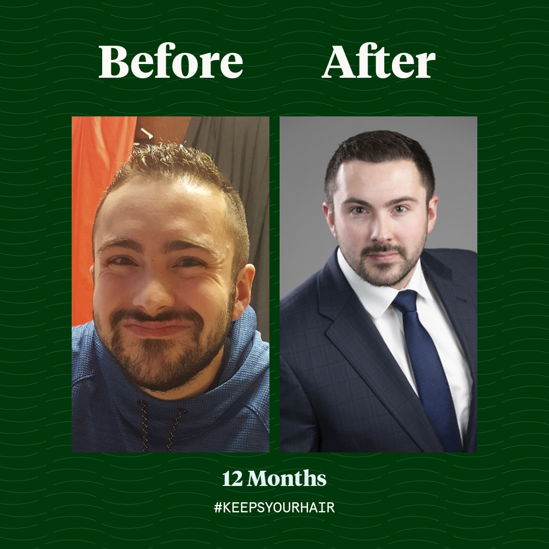 Keeps hair loss treatment reviews