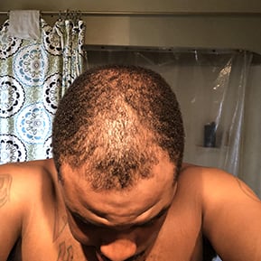 Virgil C. - before