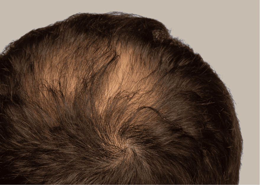 Balding At The Crown How To Stop Hair Loss Early Keeps