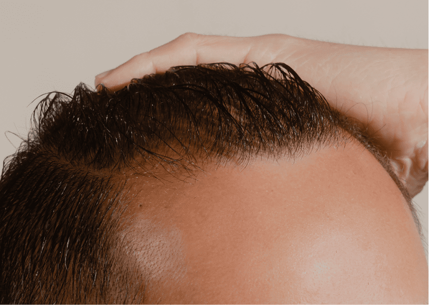 How to Treat a Receding Hairline | Keeps