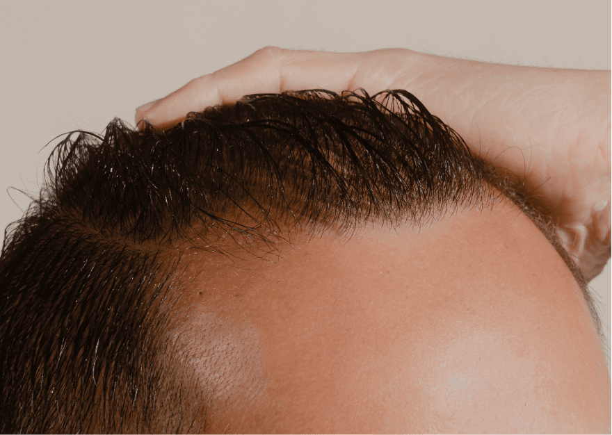 How to Treat a Receding Hairline | Keeps How to Treat a Receding Hairline | Keeps